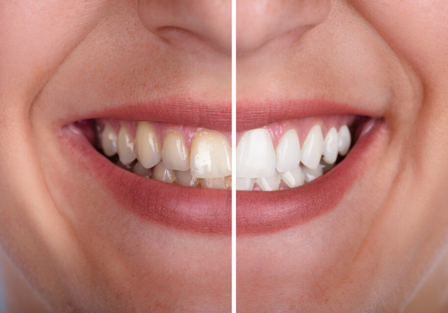 Zahnaufhellung, Zahnarzt Trier - Welschbillig