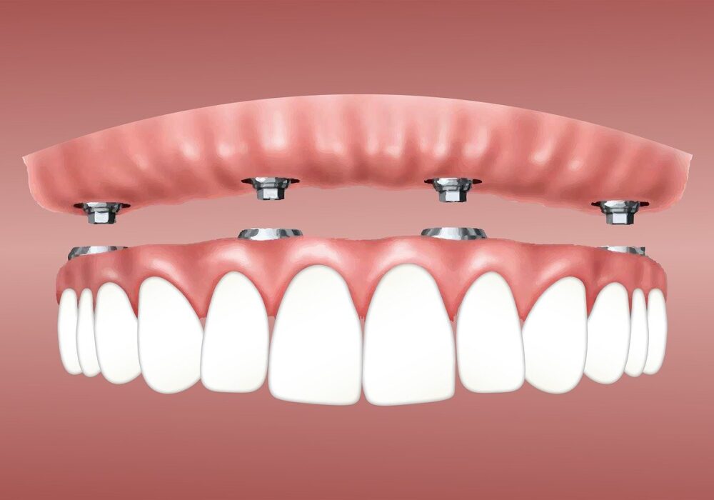 All-on-4 Zahnimplantat