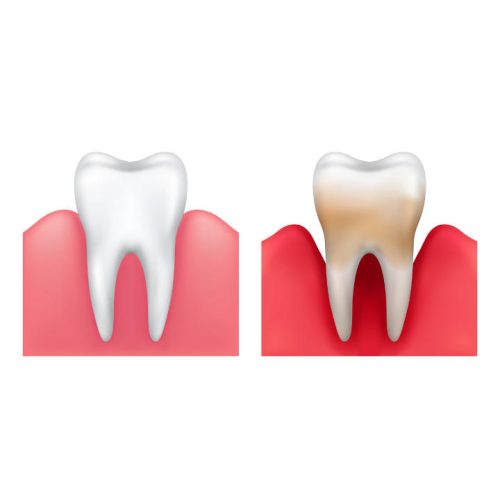 Parodontose-Therapie-trier