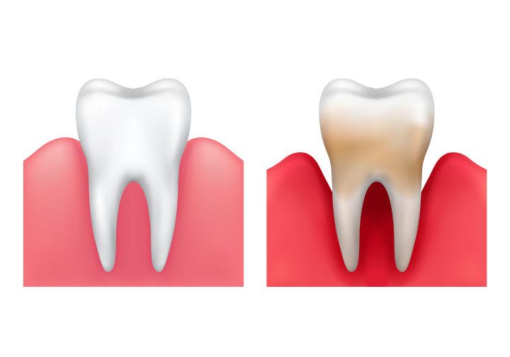 Parodontose-Therapie-trier